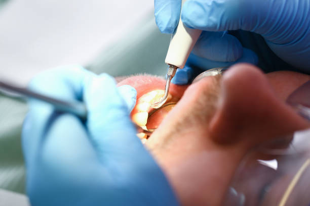 Best Emergency Tooth Extraction in Batesville, MS
