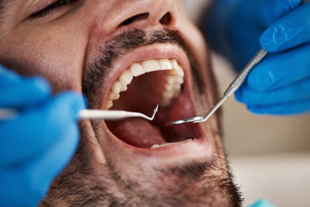Best Emergency Tooth Extraction in Batesville, MS