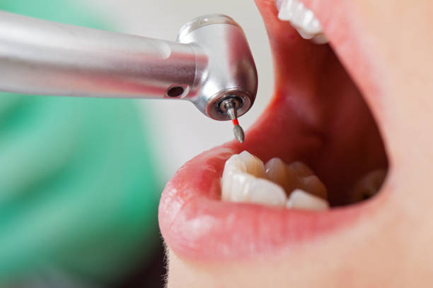 Best Emergency Tooth Extraction in Batesville, MS
